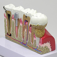 医学模型　歯と歯の諸疾患　詳細画像01