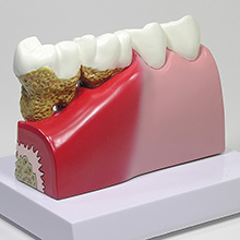 医学模型　歯と歯の諸疾患　詳細画像02
