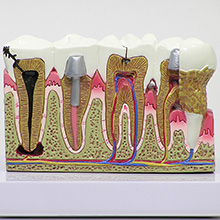 医学模型　歯と歯の諸疾患　詳細画像03