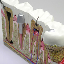 医学模型　歯と歯の諸疾患　詳細画像04