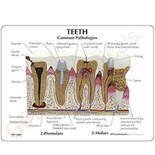 医学模型　歯と歯の諸疾患　詳細画像05