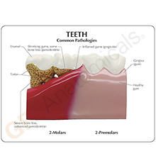医学模型　歯と歯の諸疾患　詳細画像06