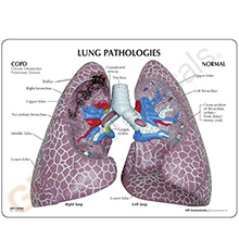 医学模型　肺の主要疾患　詳細画像04
