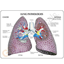 医学模型　肺の主要疾患　詳細画像05