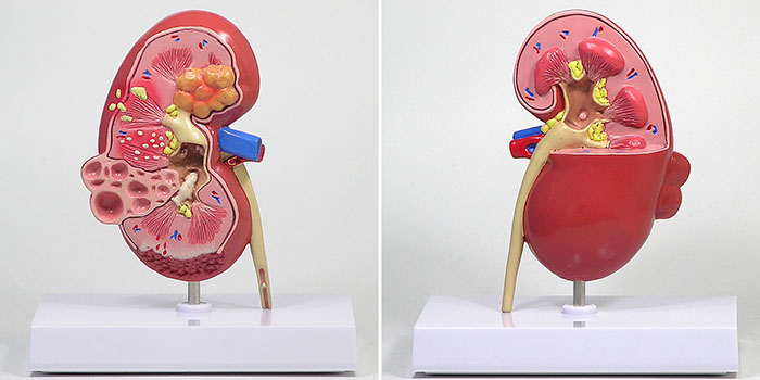 人体模型　腎臓と諸疾患　詳細画像01
