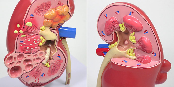 人体模型　腎臓と諸疾患　詳細画像02
