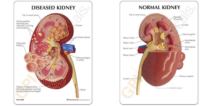 人体模型　腎臓と諸疾患　詳細画像03