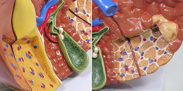 人体模型　肝臓と諸疾患　詳細画像03