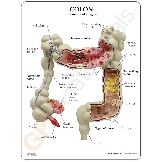 医学模型　大腸諸疾患　英文イラストカード