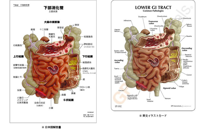 医学模型　大腸・小腸の諸疾患　詳細画像02