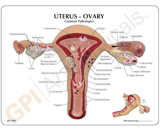 医学模型　子宮と卵巣の諸疾患　英文イラストカード