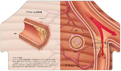 型抜き絵本 アテローム性動脈硬化 05-06ページ