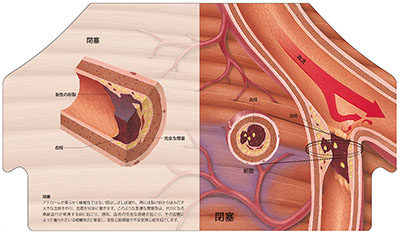 型抜き絵本 アテローム性動脈硬化 09-10ページ