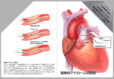 型抜き絵本 冠状動脈の血行再建術 01-02ページ