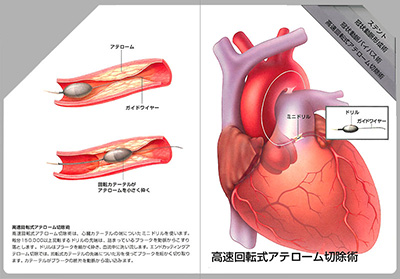 型抜き絵本 冠状動脈の血行再建術 03-04ページ