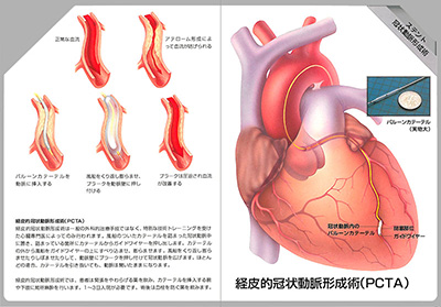 型抜き絵本 冠状動脈の血行再建術 07-08ページ