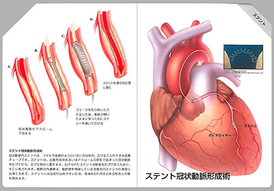 型抜き絵本 冠状動脈の血行再建術 09-10ページ