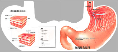 型抜き絵本 胃・食道・十二指腸の炎症と潰瘍 03-04ページ