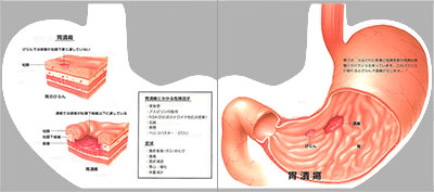 型抜き絵本 胃・食道・十二指腸の炎症と潰瘍 07-08ページ