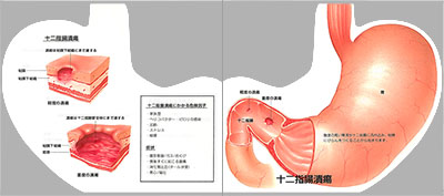 型抜き絵本 胃・食道・十二指腸の炎症と潰瘍 09-10ページ