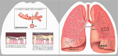 型抜き絵本 慢性閉塞性肺疾患と肺癌 05-06ページ