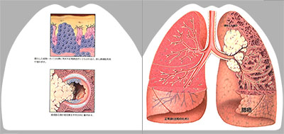 型抜き絵本 慢性閉塞性肺疾患と肺癌 09-10ページ