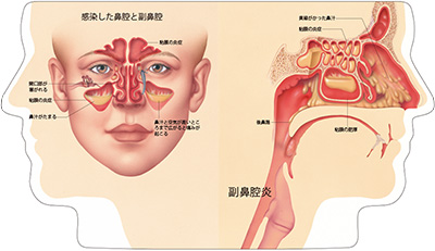 型抜き絵本 鼻腔と副鼻腔疾患 09-10ページ