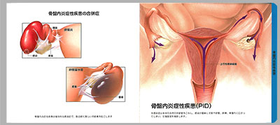 型抜き絵本 女性性器と痛み 09-10ページ